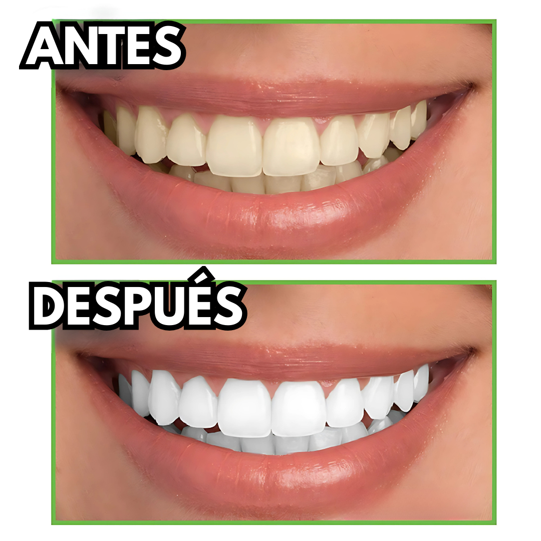 MIRACLE TEETH – Blanquea y limpia tu sonrisa de manera natural