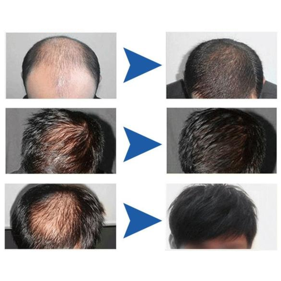 SUERO CAPILAR MONOXIDIL 5% – Reactiva el crecimiento y fortalece el cabello masculino