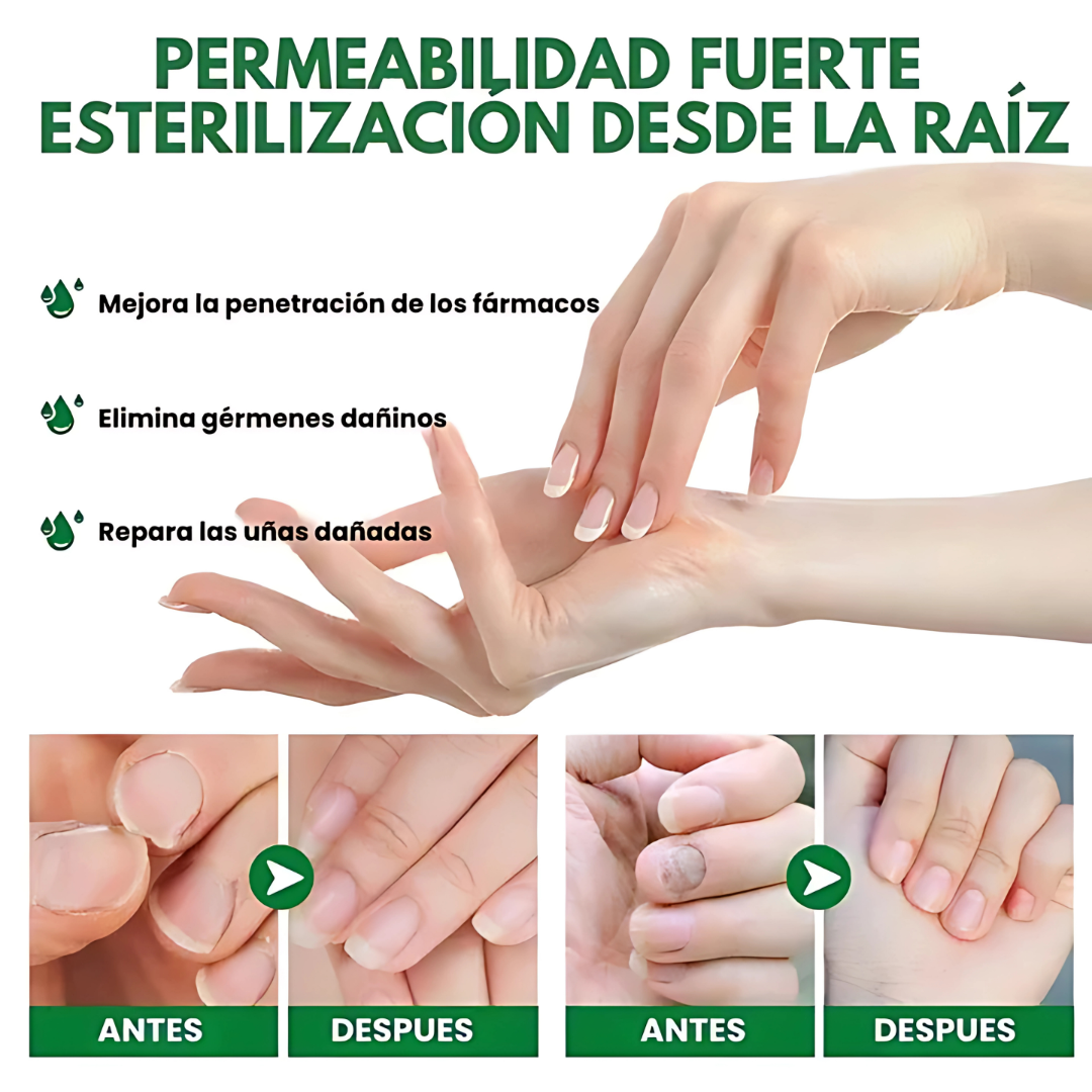 Removedor de Hongos – Limpia y recupera la salud de tus uñas