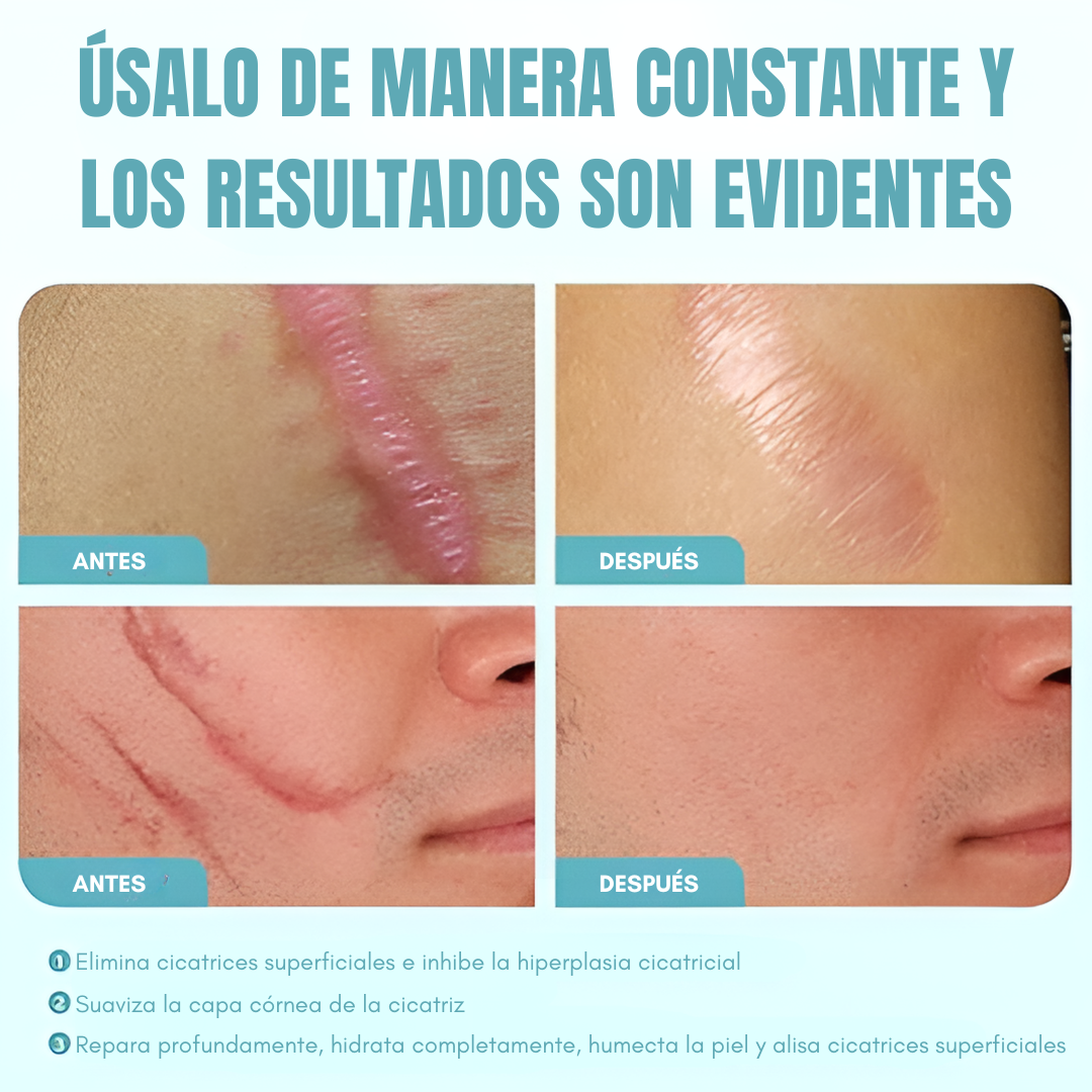 GEL PARA ELIMINAR CICATRICES – Regenera y suaviza tu piel