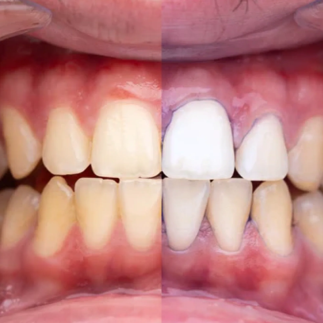 Pasta dental BrightBerry - Di adiós al tono amarillento y luce una sonrisa impecable.